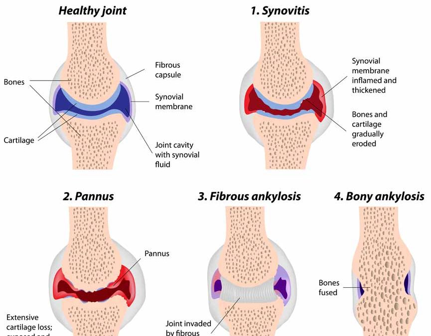 stages-of-rheumatoid-arthritis