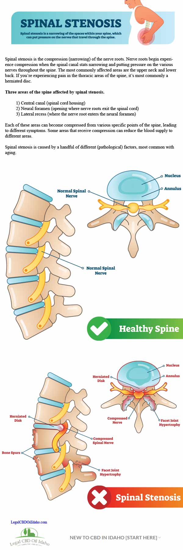 infographic---what-is-spinal-stenosis
